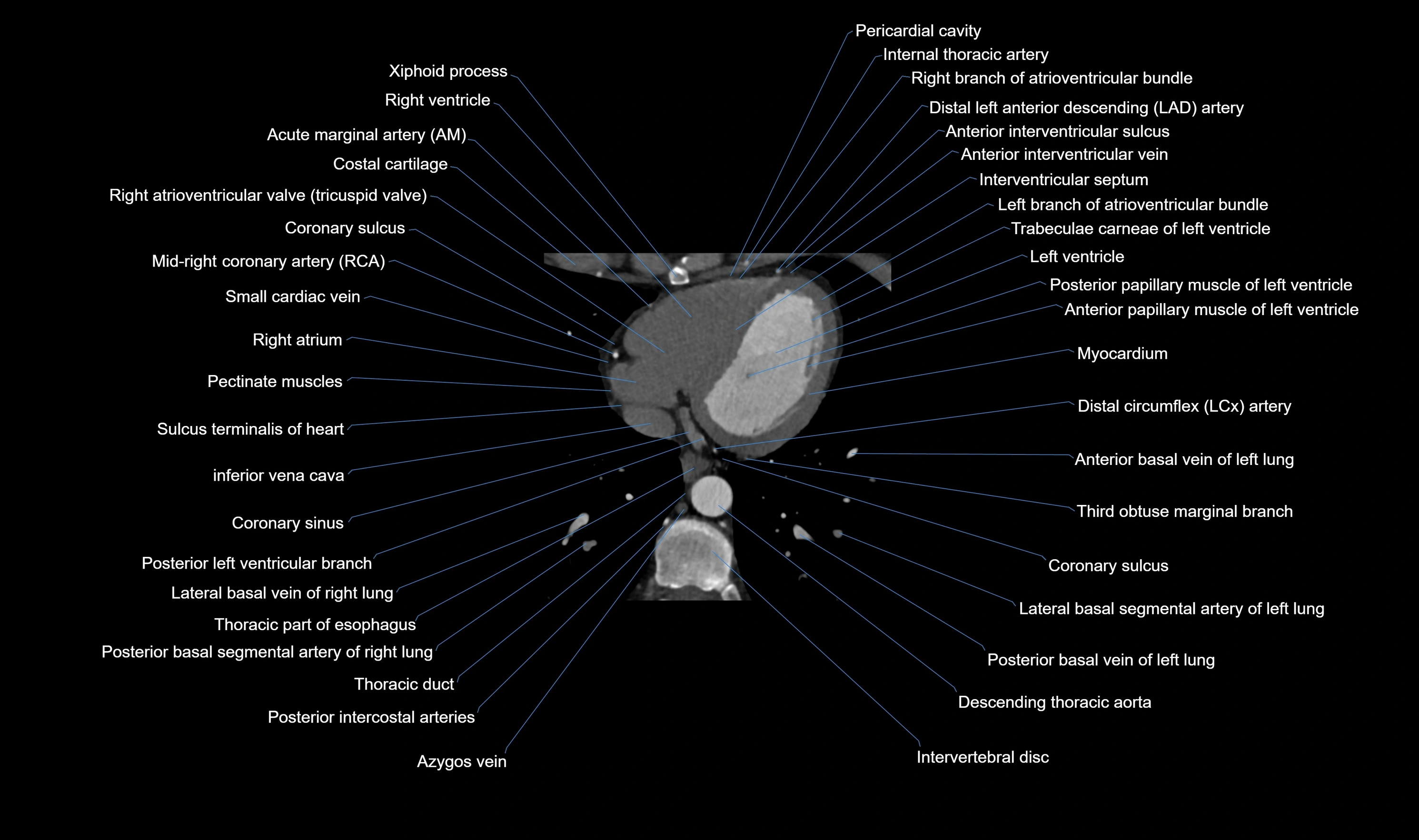 CT heart (coronary angiogram) axial view cross sectional anatomy labelled radiology image-00051.webp